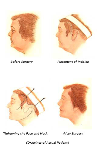 Illustration of facelift procedure